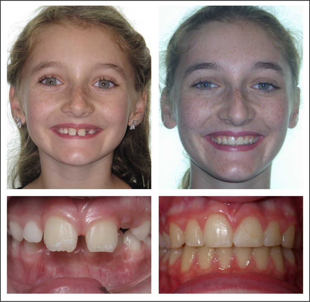 Orthodontic treatment for children