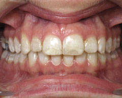 Orthodontic Treatment Case Study