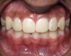 Orthodontic Treatment Case Study