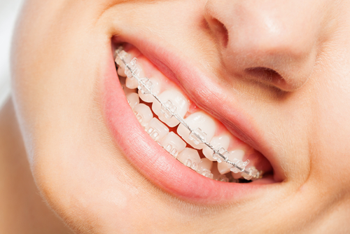 love your dental braces philadelphia orthodontists center city