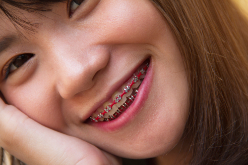 summer braces invisalign teen philadelphia orthodontists