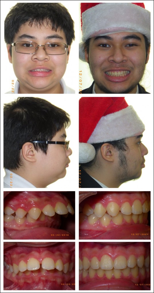 Orthodontic treatment for children