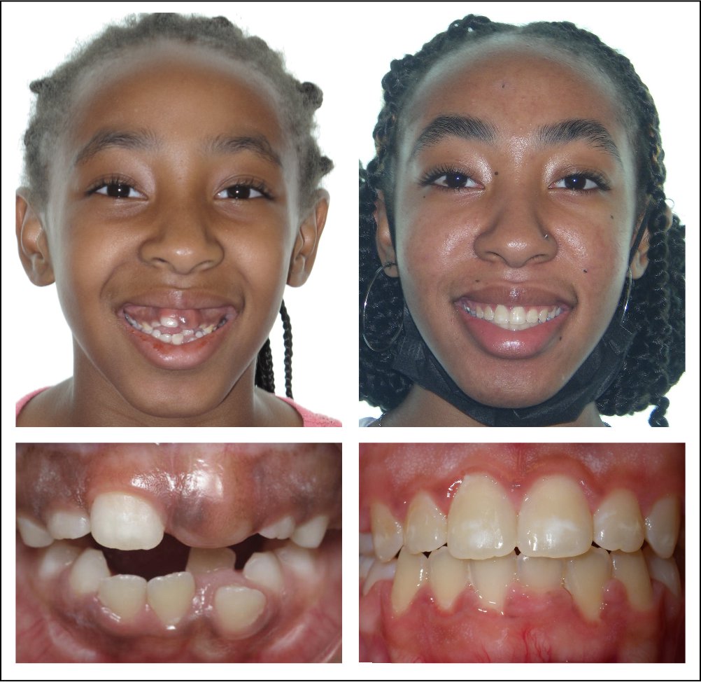 Orthodontic treatment for children