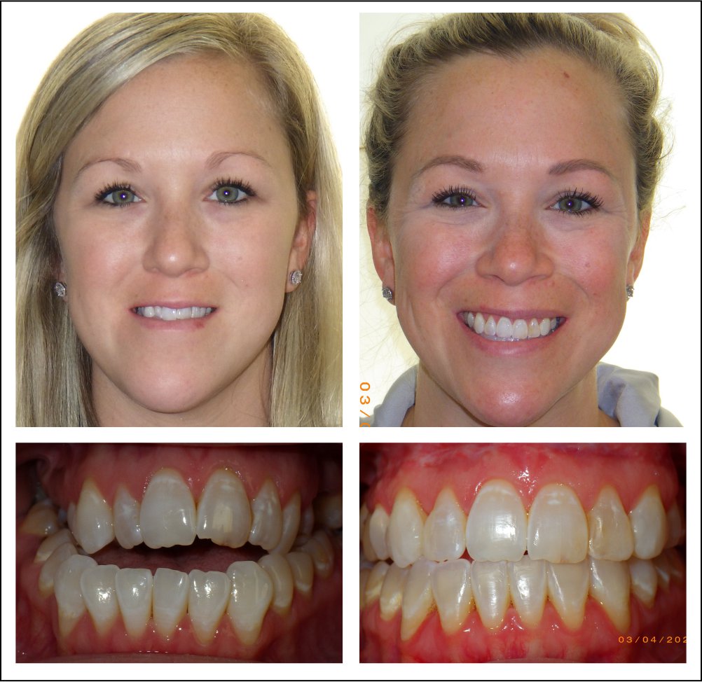 Orthodontic treatment for children