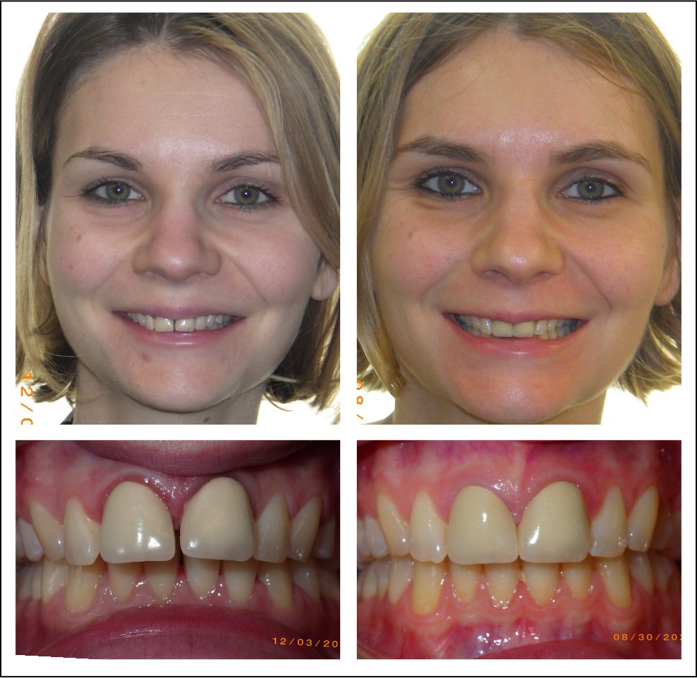 Orthodontic treatment for children