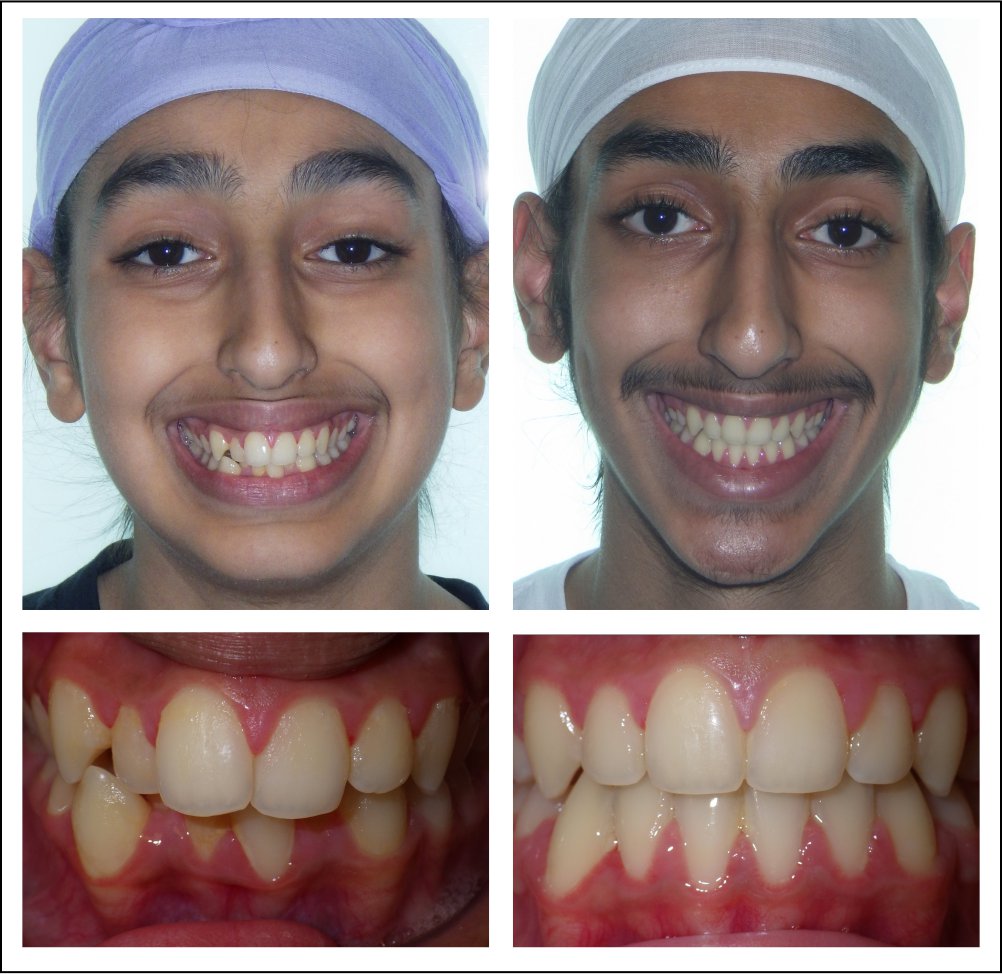 Orthodontic treatment for children