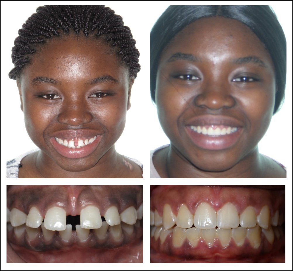 Orthodontic treatment for children