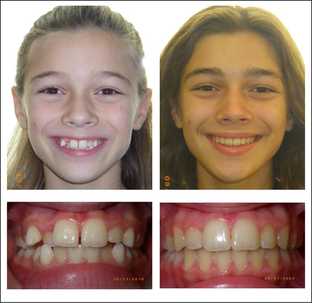 Orthodontic treatment for children