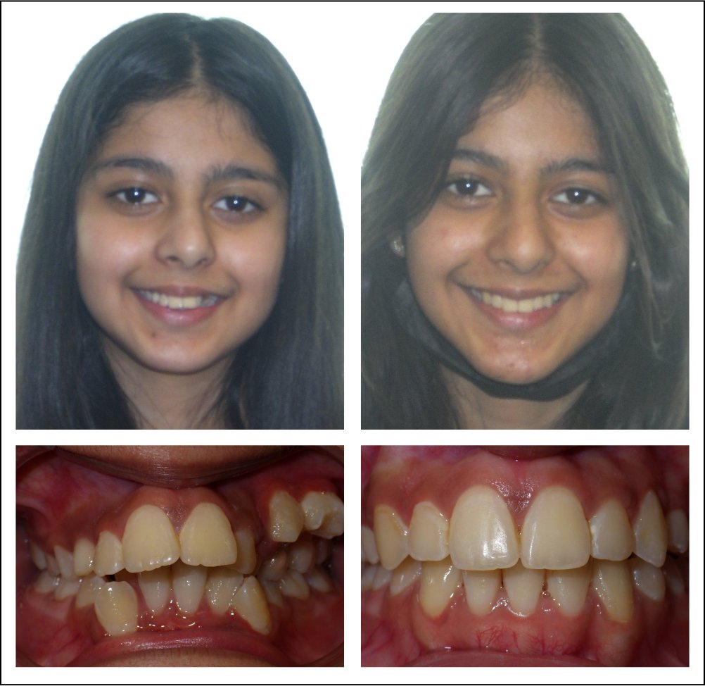 Orthodontic treatment for children