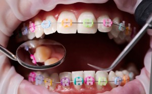 braces rubber bands elastics philadelphia orthodontists