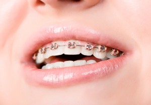 personality braces orthodontics center city philadelphia