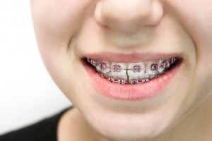 help teens prepare for braces philadelphia orthodontists