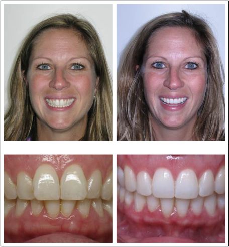 Invisalign Case Study