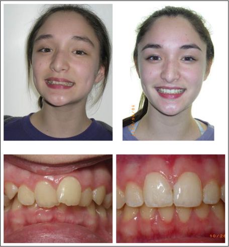 Orthodontic treatment for children