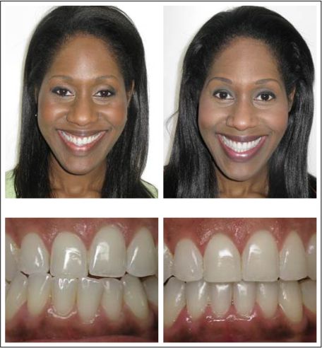 Invisalign Case Study