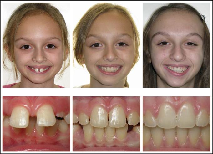 Children two stage orthodontic treatment