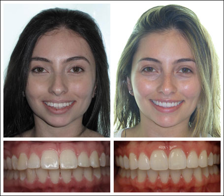 Invisalign treatment