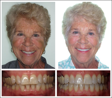 Invisalign treatment