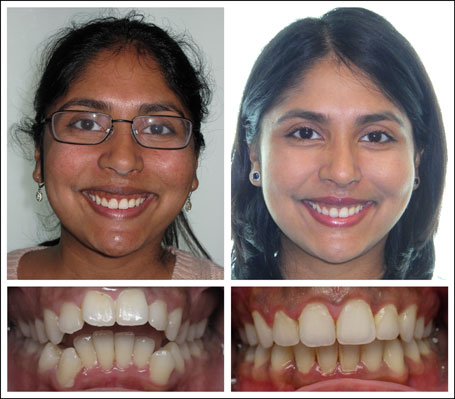 Braces adult treatment