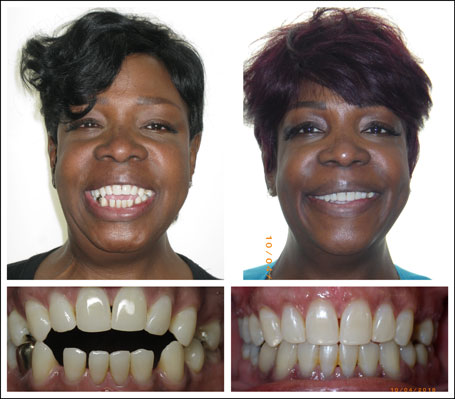 Braces and Invisalign