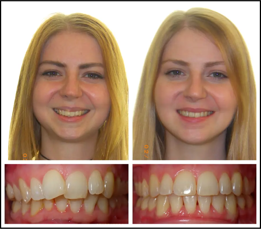 Orthognathic Surgery