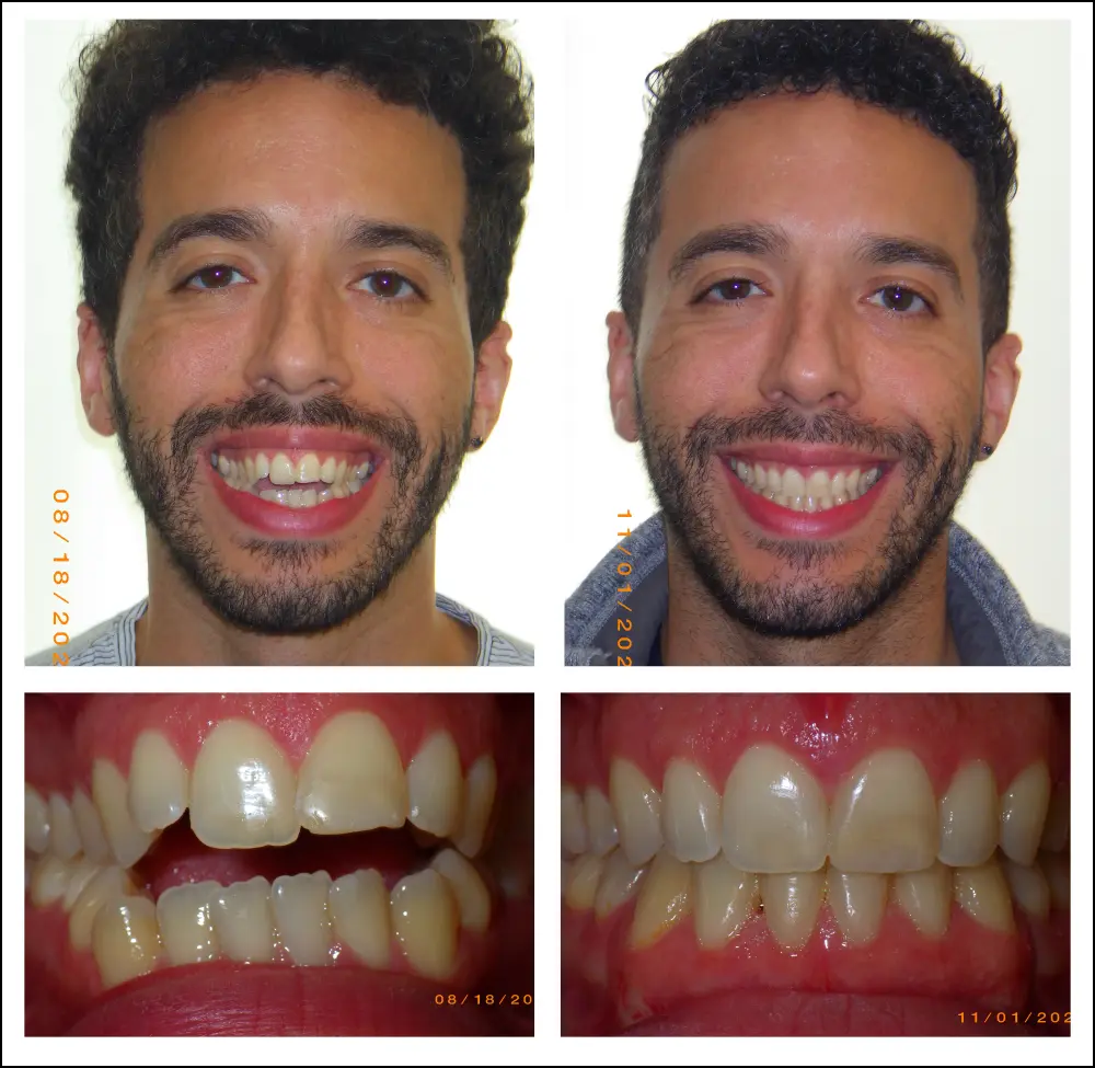 Orthodontic treatment for adults