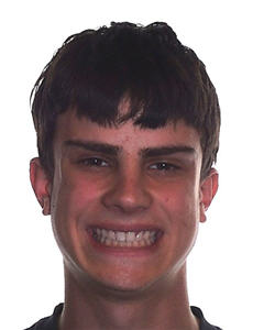 Orthodontic Treatment Case Study