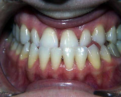 Orthodontic Treatment Case Study