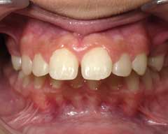 Orthodontic Treatment Case Study