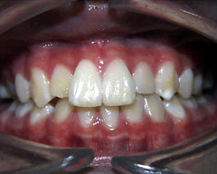 Orthodontic Treatment Case Study