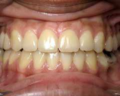 Orthodontic Treatment Case Study