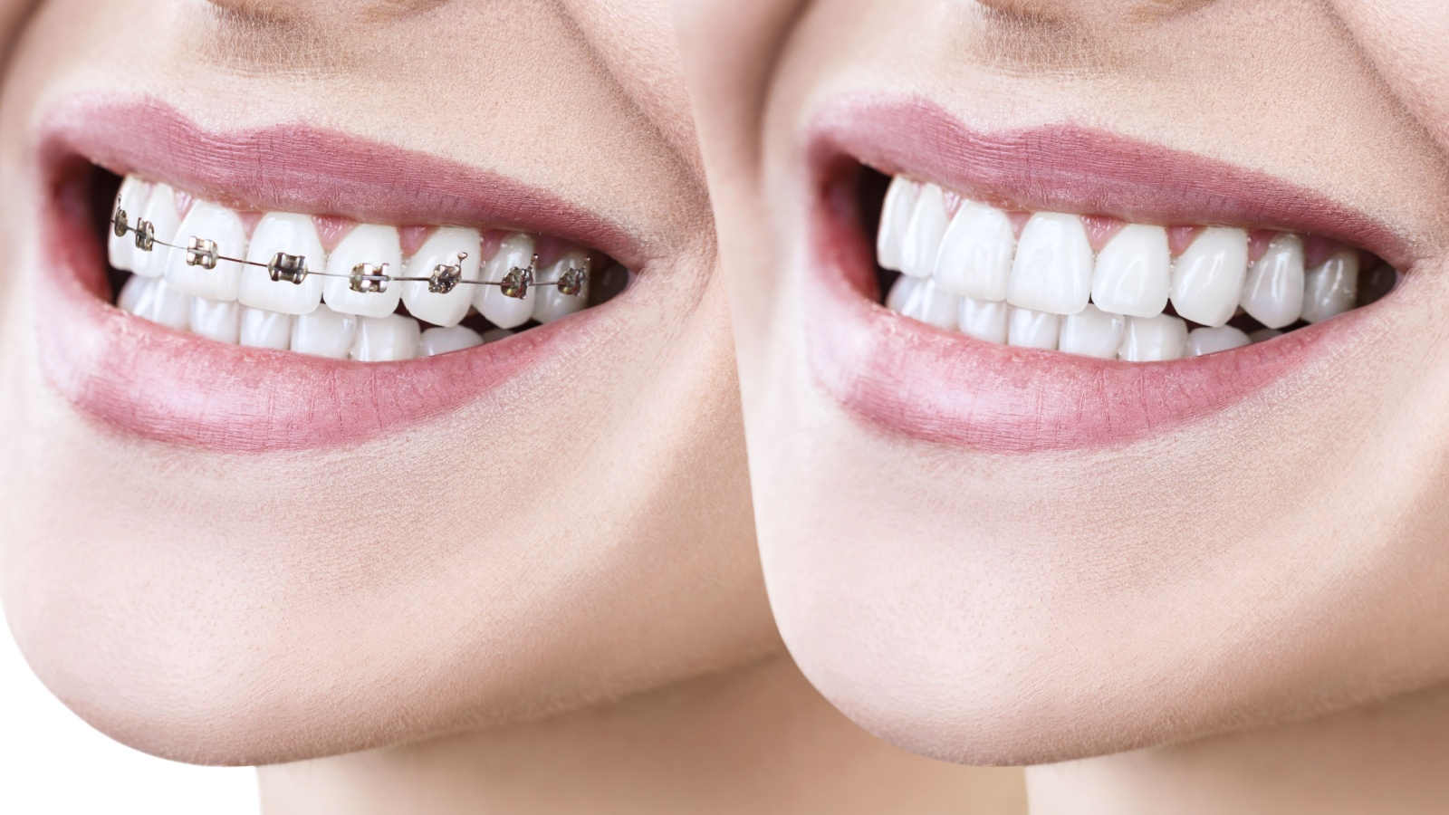 smile gallery blog