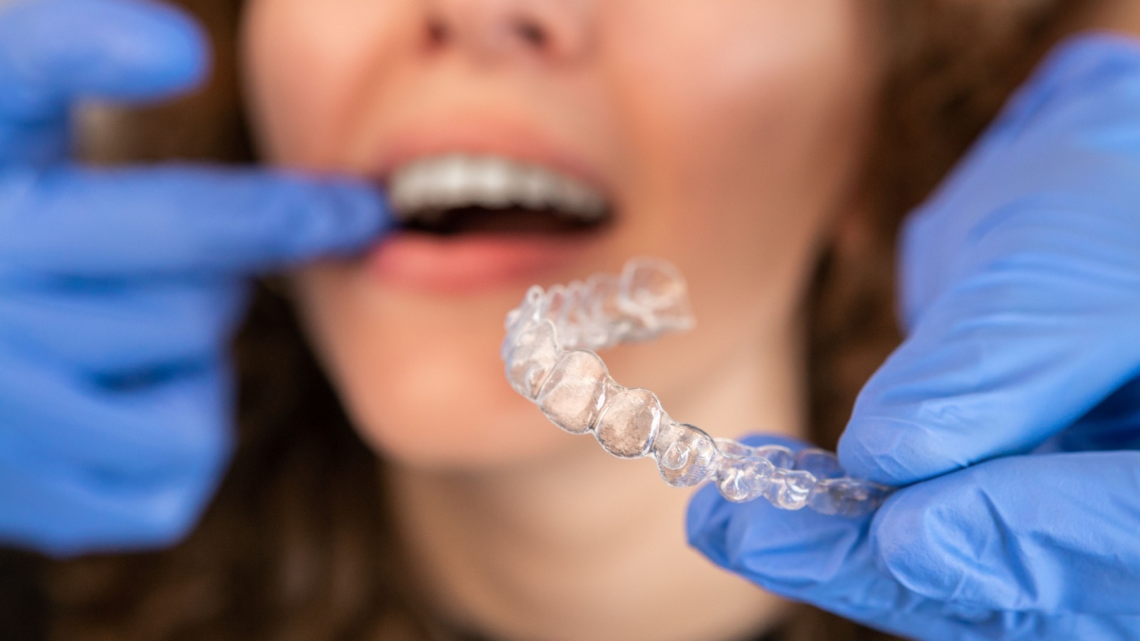 invisalign questions