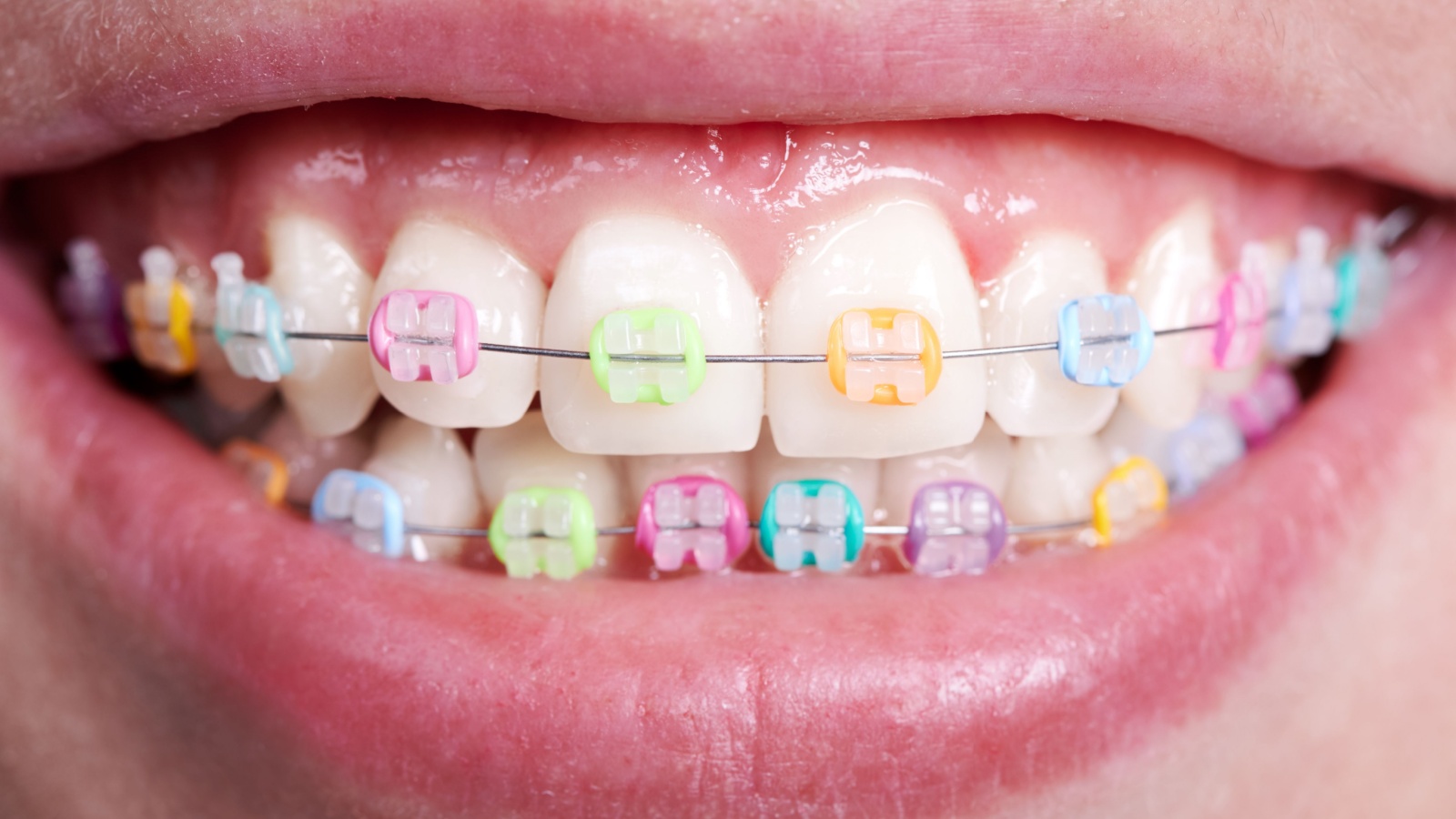 Choose the Braces Color That Suits Your Personality