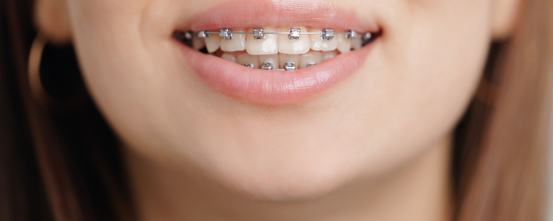 dental braces