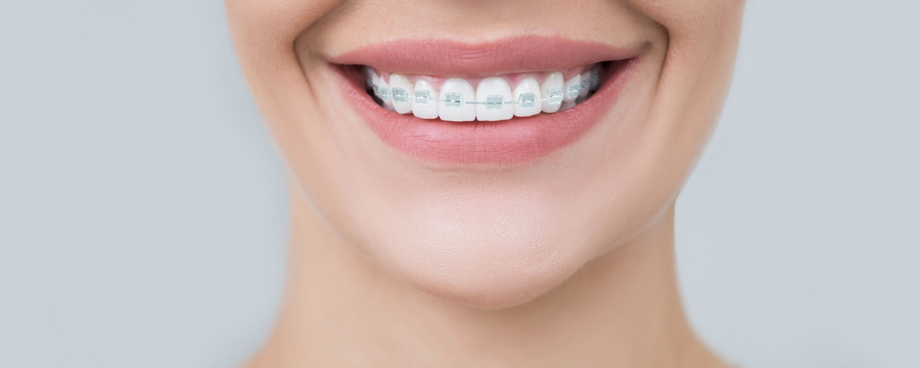 clear braces