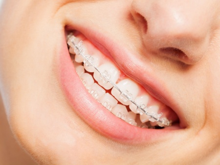 clear braces