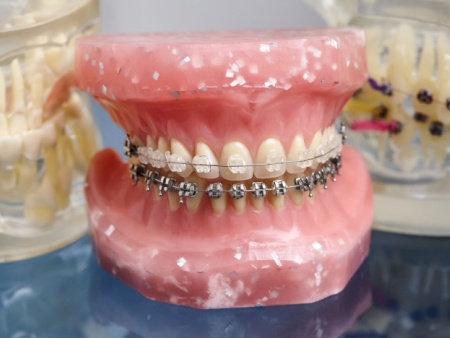 clear braces