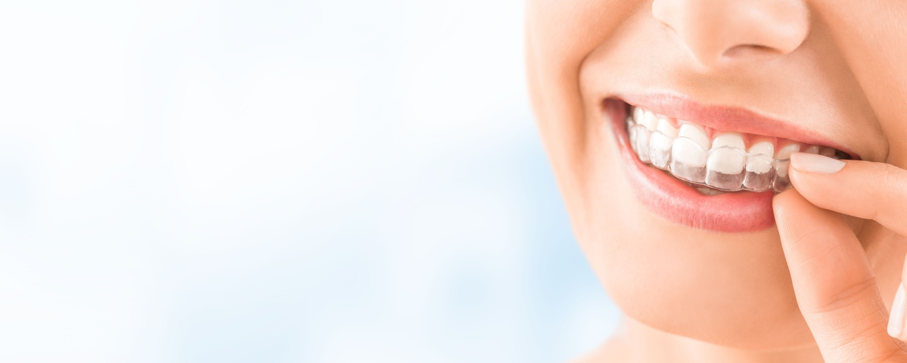 invisalign