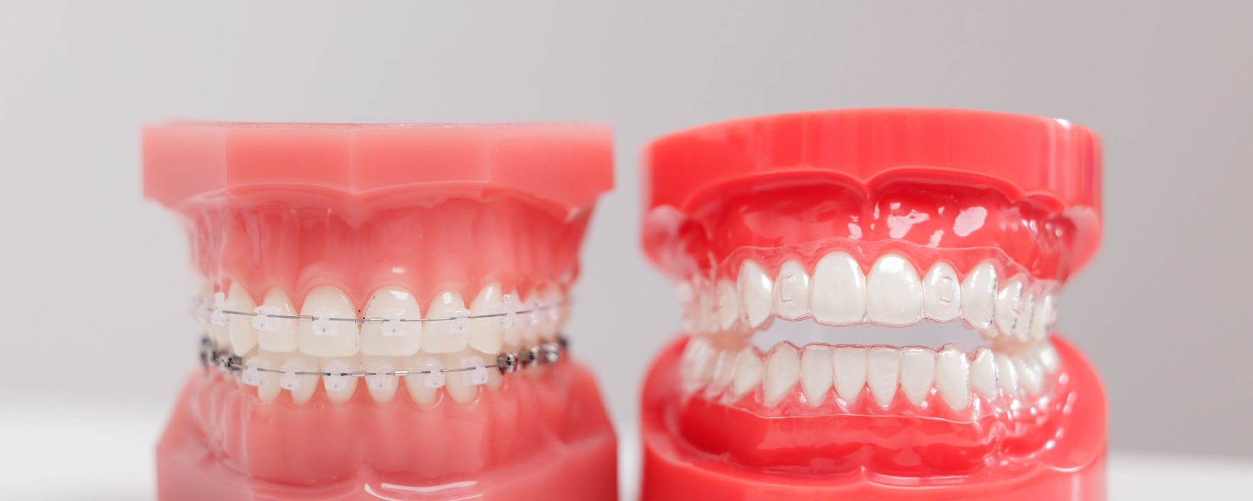 Braces vs Invisalign® Comparison